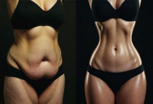 insane 360 circumferential body lift transformation