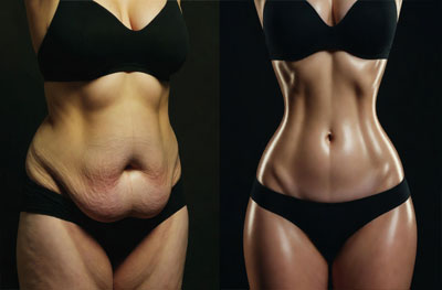 insane 360 circumferential body lift transformation